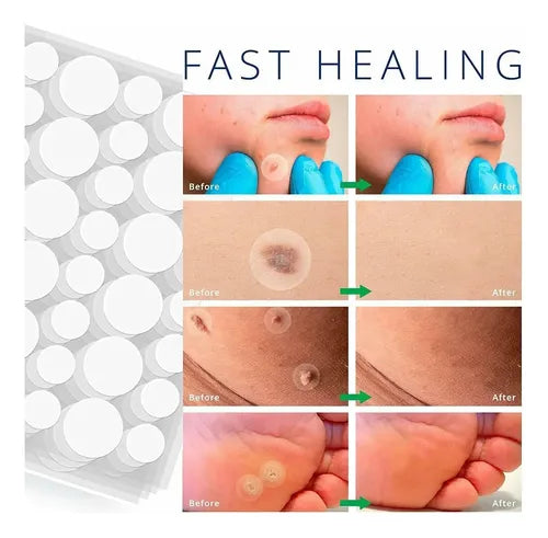 Parches Anti Verrugas Patch – Tratamiento Discreto para Verrugas sin dolor