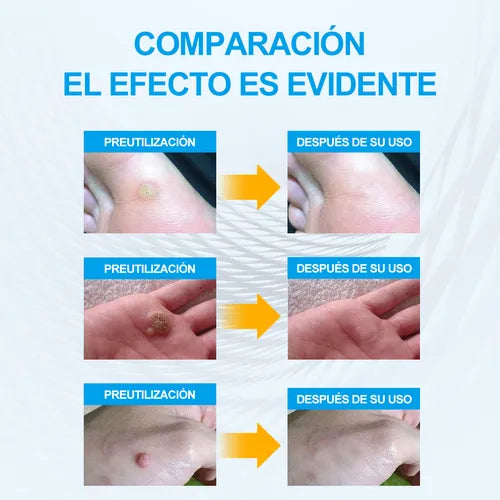 Parches Anti Verrugas Patch – Tratamiento Discreto para Verrugas sin dolor