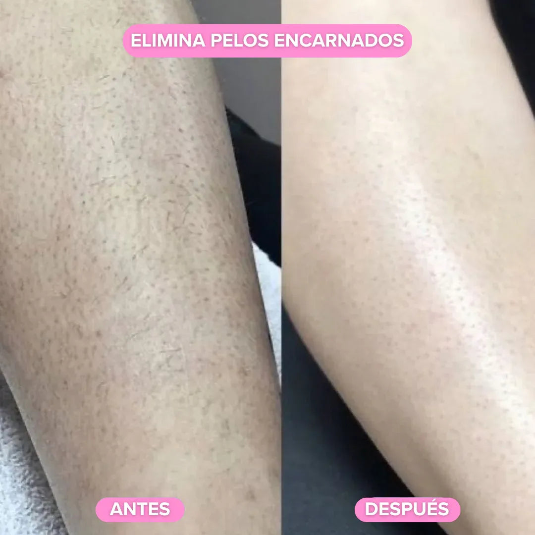 Depiladora Anivelle®